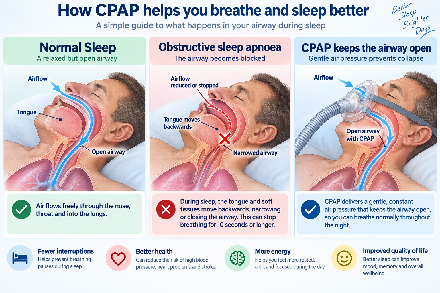 Diagram showing normal sleep breathing, obstructive sleep apnoea with a narrowed airway, and CPAP keeping the airway open